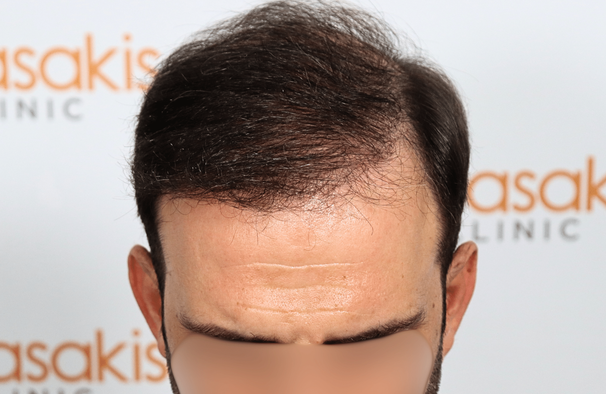 hair transplant 2600 fus thin 1st stage