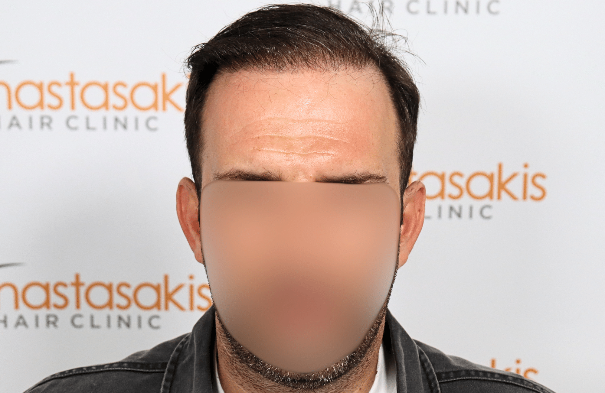 hair transplant 2600 fus thin 1st stage