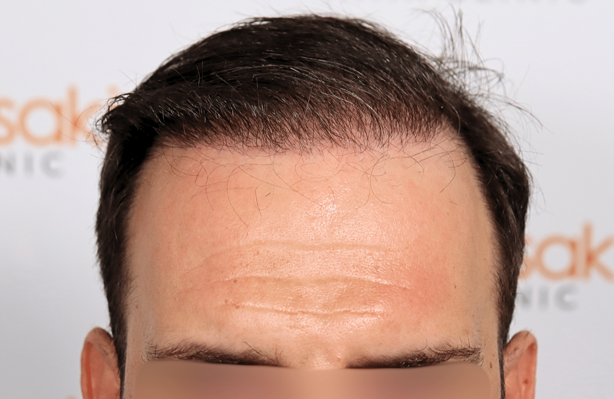 hair transplant 2600 fus thin 1st stage