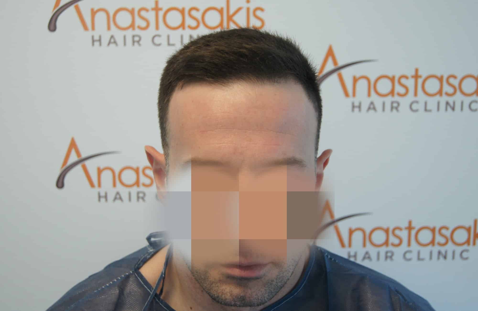 περιστατικο πριν τη μεταμόσχευση μαλλιων στην anastasakis hair clinic