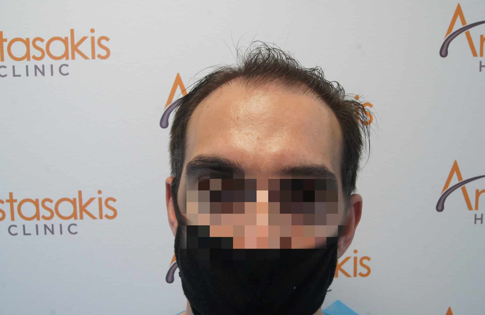 περιστατικο πριν τη μεταμόσχευση μαλλιων στην anastasakis hair clinic