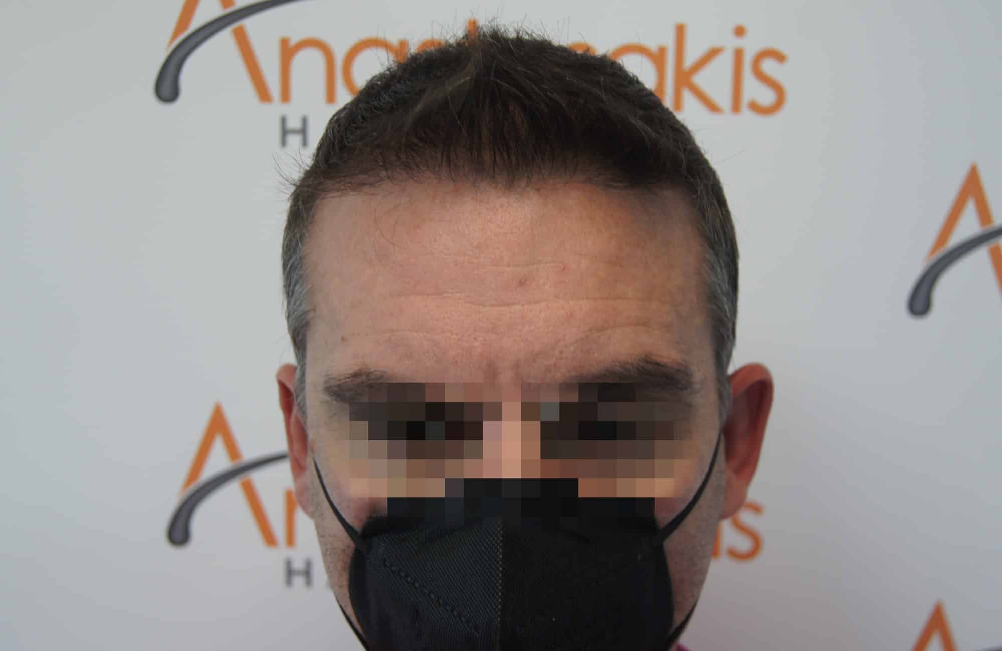 περιστατικο μετα τη μεταμόσχευση μαλλιων με 3200 fus στην anastasakis hair clinic