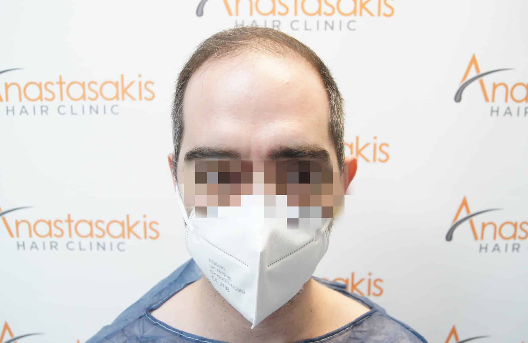 περιστατικο πριν τη μεταμοσχευση μαλλιων με 2500 fus