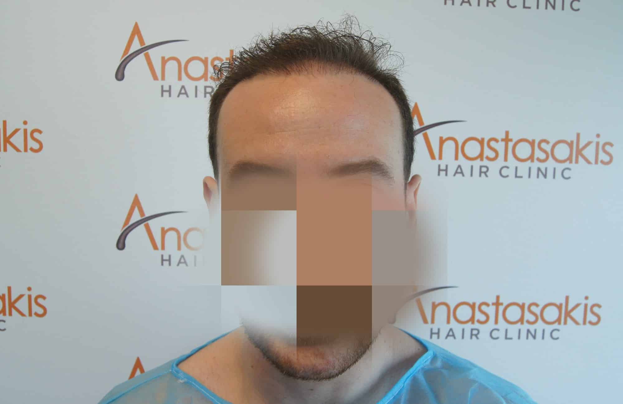 περιστατικο μεταμοσχευσης μαλλιών πριν από τη μμ 2500 τριχοθυλακίων
