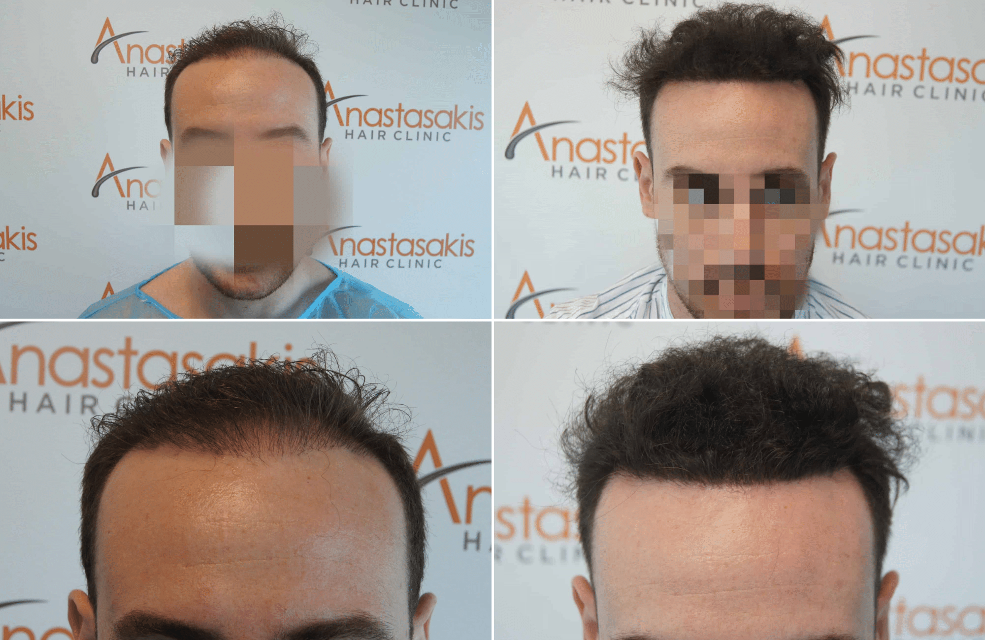 https://anastasakishairclinic.com/portfolio/apotelesma-metamosxefsis-mallion-anastasakis-hair-clinic-306/