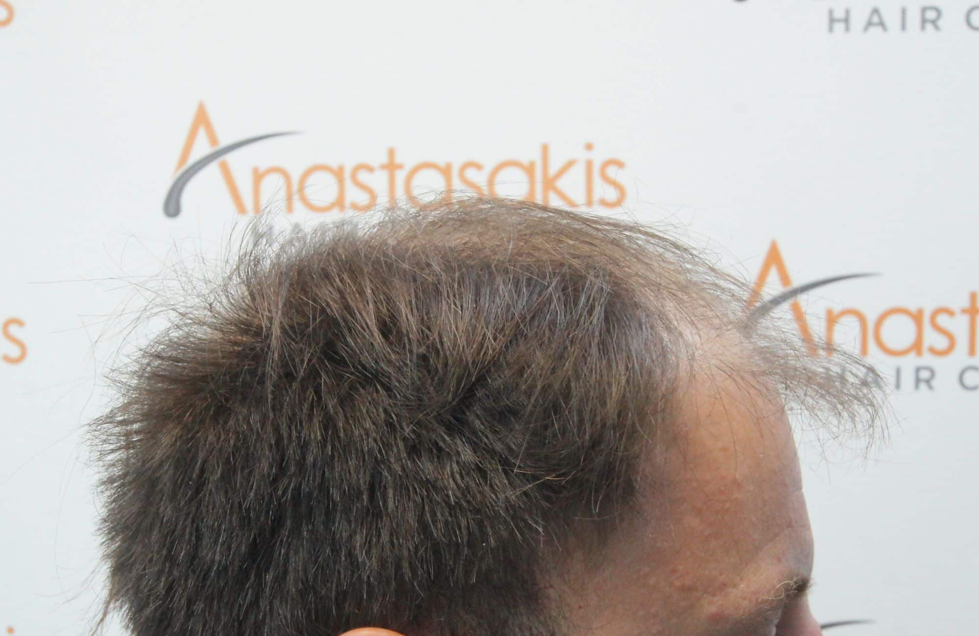 περιστατικο μεταμοσχευσης μαλλιων πριν τη μεταμοσχευση - side 3