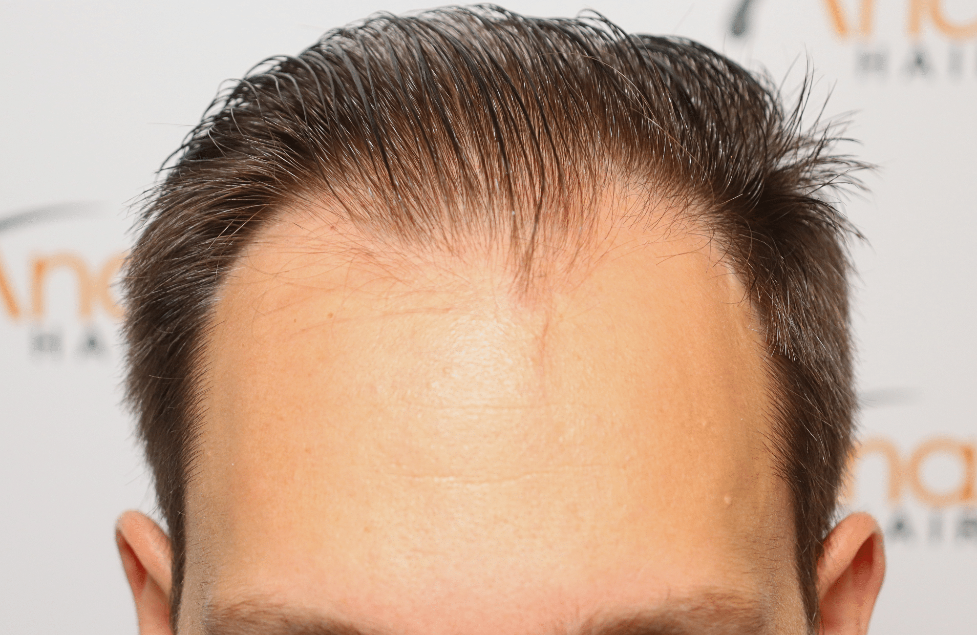 hair transplant 3500 fus stage 5 thin