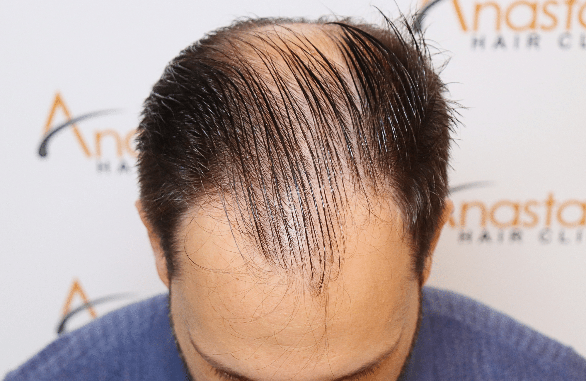 hair transplant 3500 fus stage 5 thin