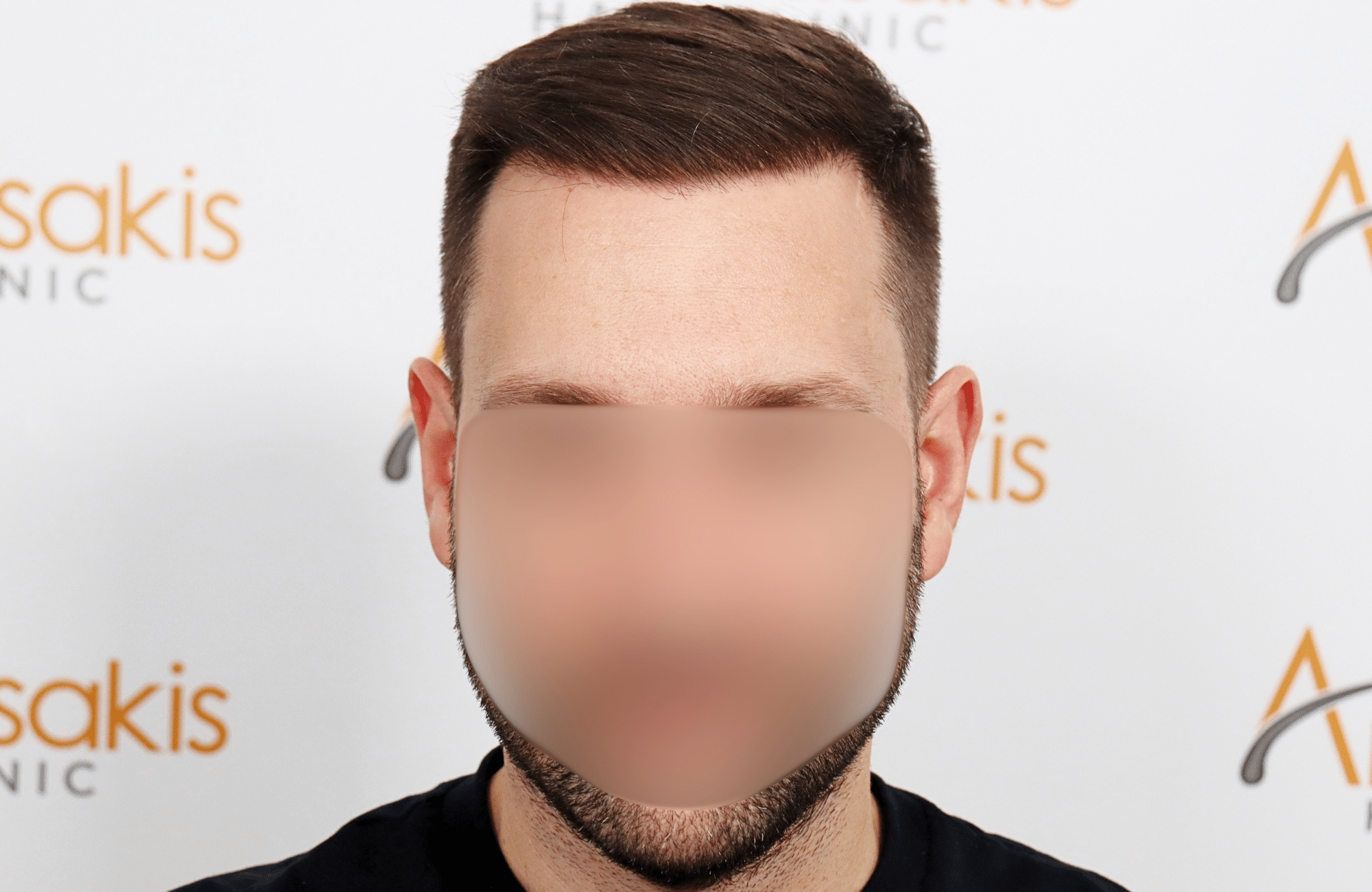 hair transplant 3500 fus stage 5 thin
