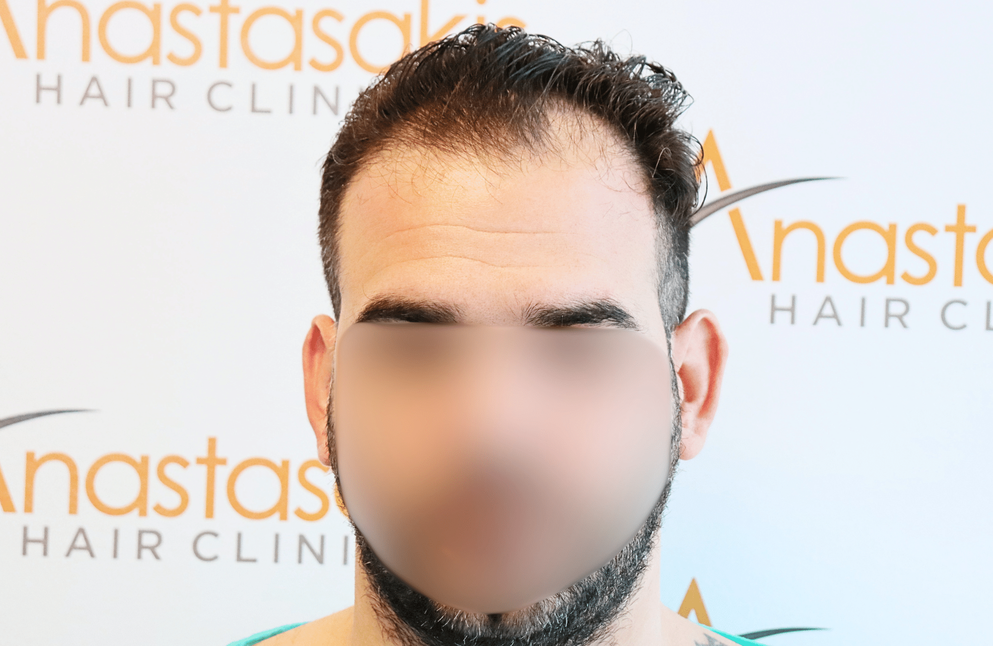 hair transplant result 2300 fus thick frontal (9)