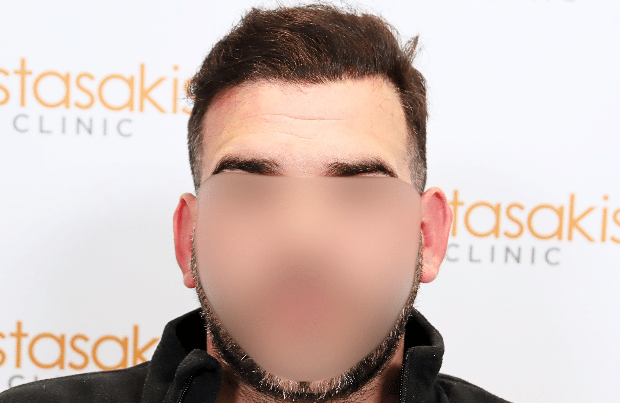 hair transplant result 2300 fus thick frontal (9)