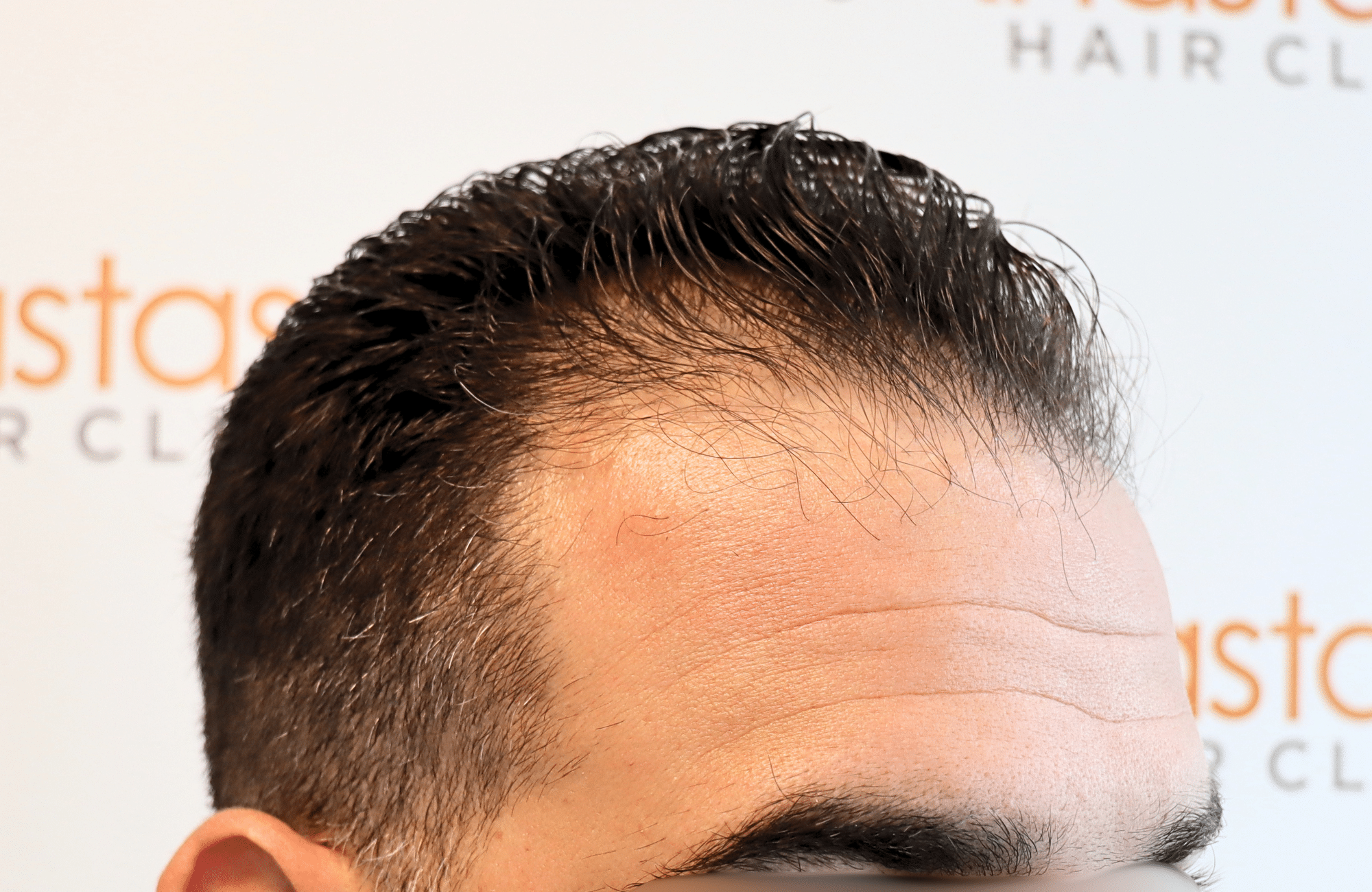 hair transplant result 2300 fus thick frontal