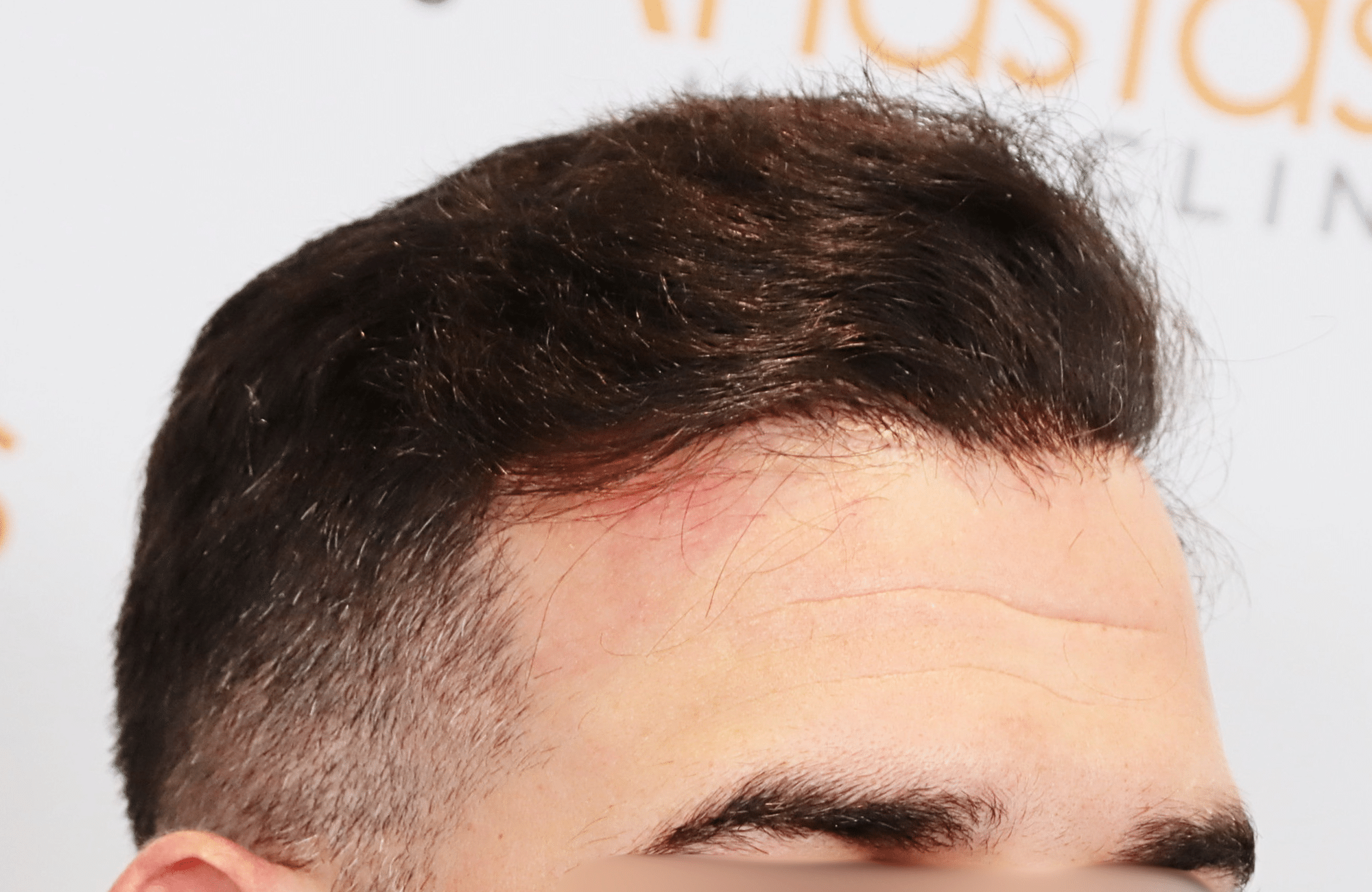 hair transplant result 2300 fus thick frontal