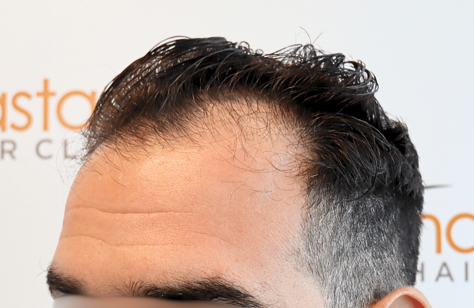 hair transplant result 2300 fus thick frontal (9)