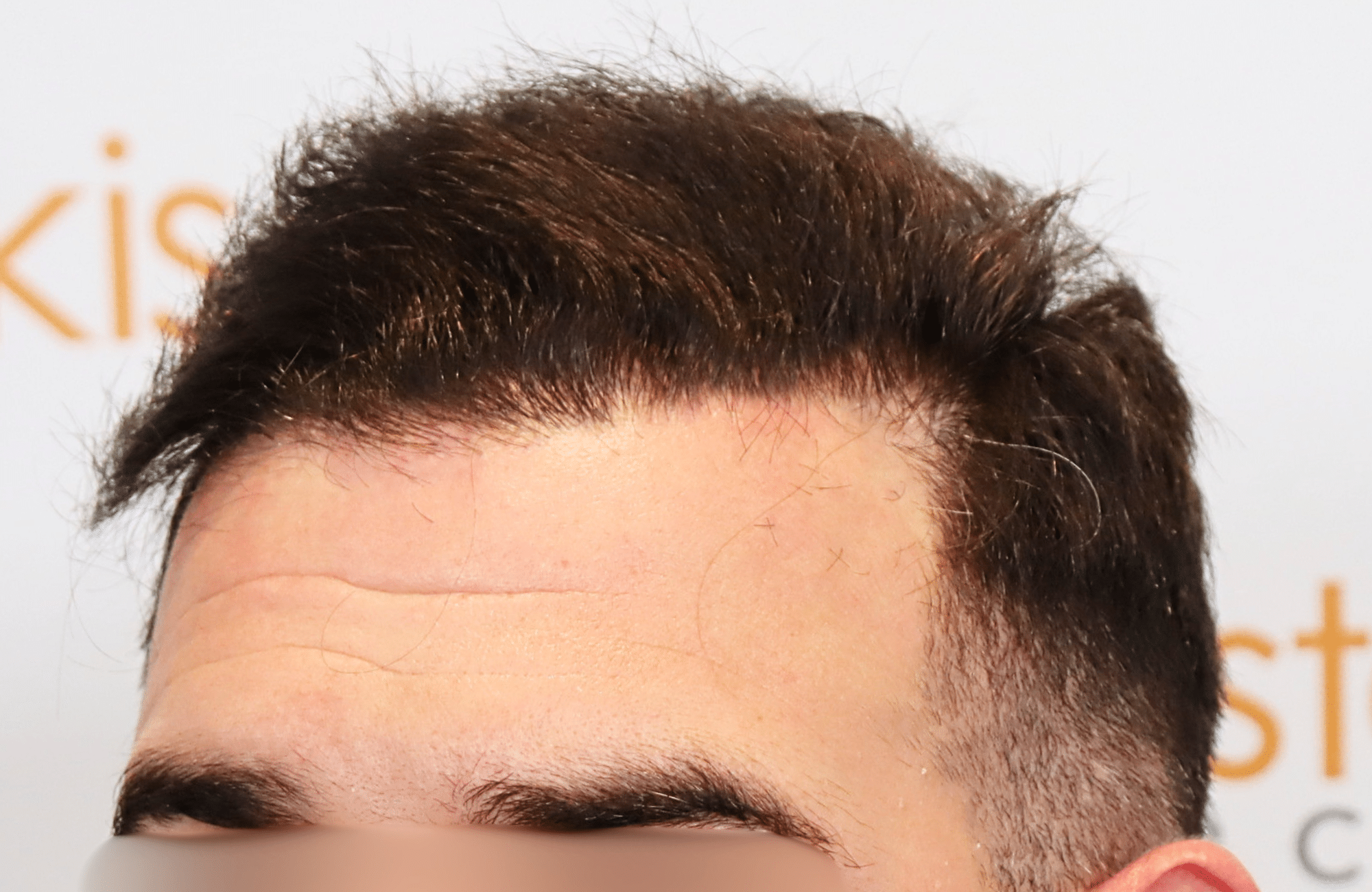 hair transplant result 2300 fus thick frontal (9)