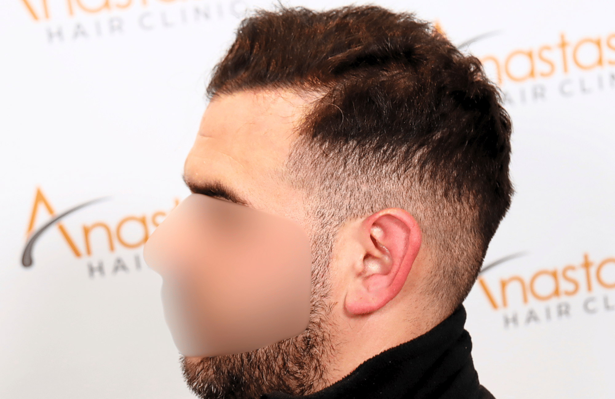 hair transplant result 2300 fus thick frontal