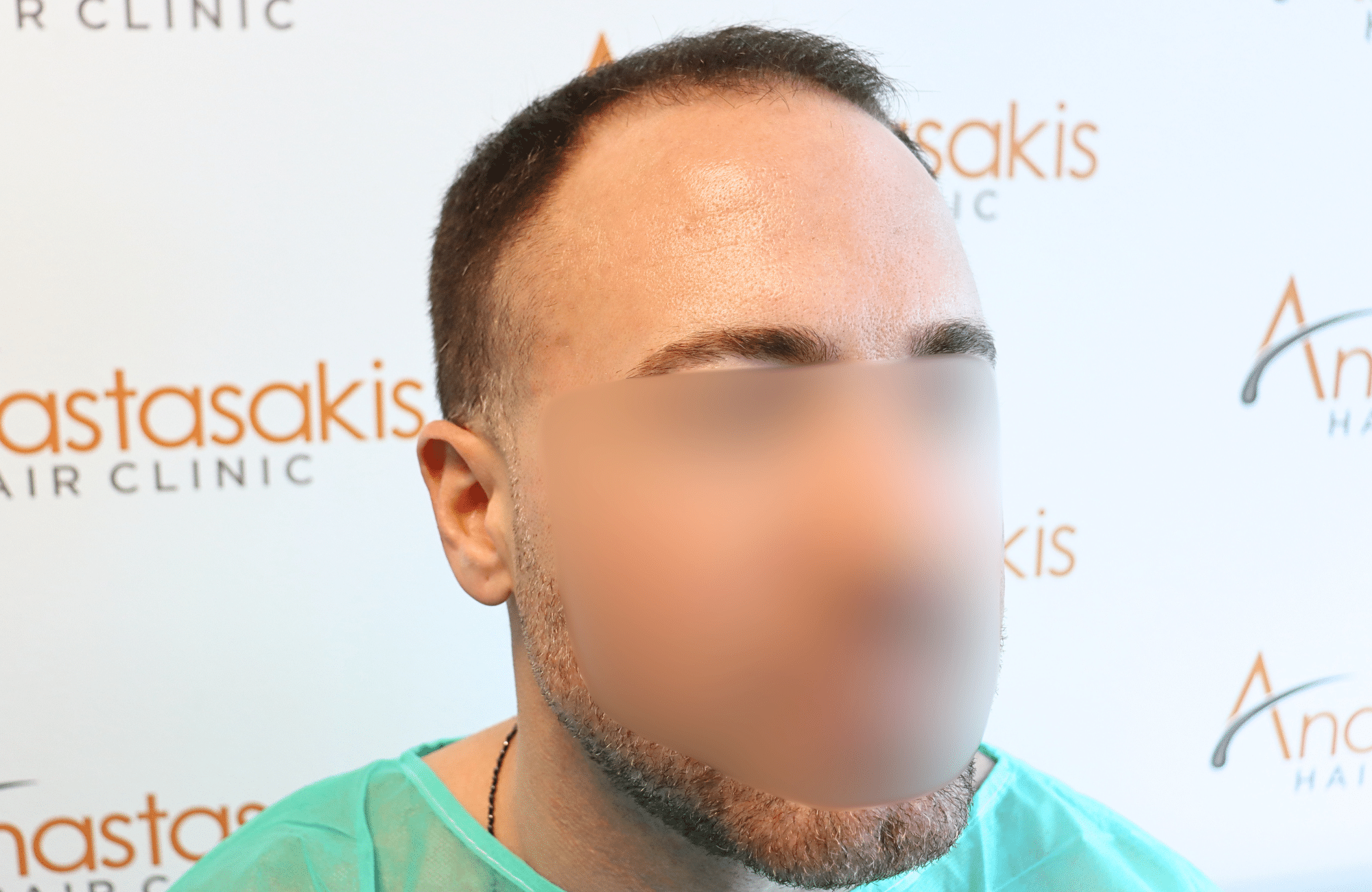 hair transplant tesult 2600 fus frontal stage 5