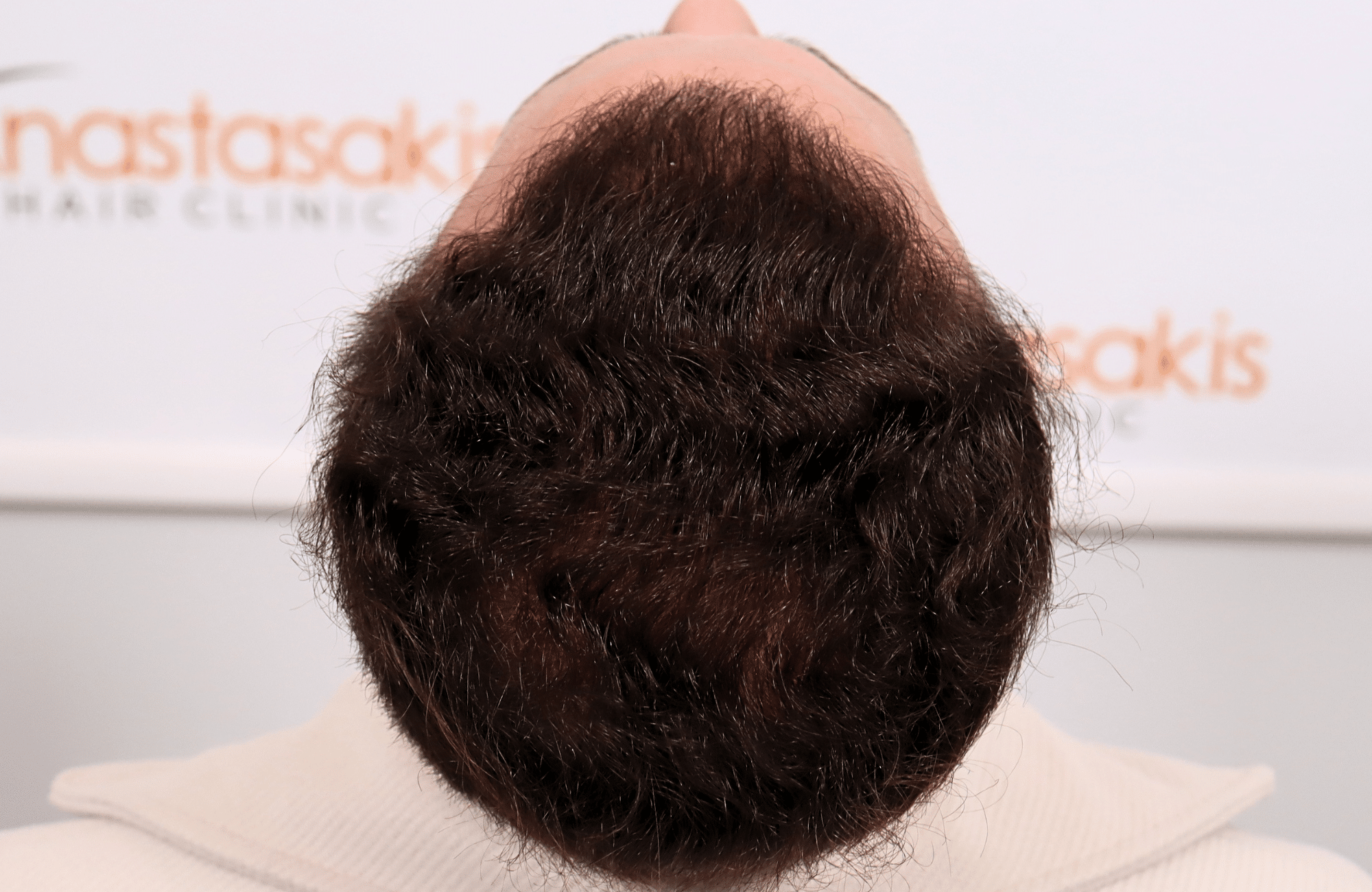 hair transplant tesult 2600 fus frontal stage 5