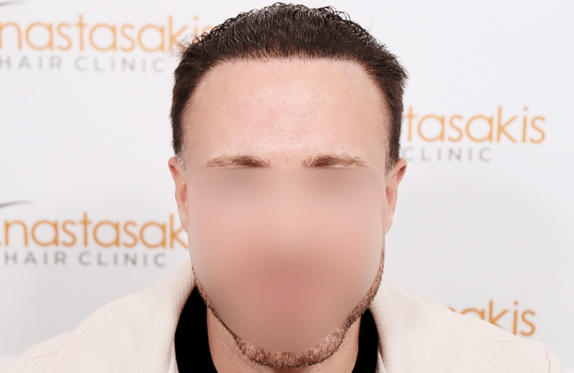 hair transplant tesult 2600 fus frontal stage 5