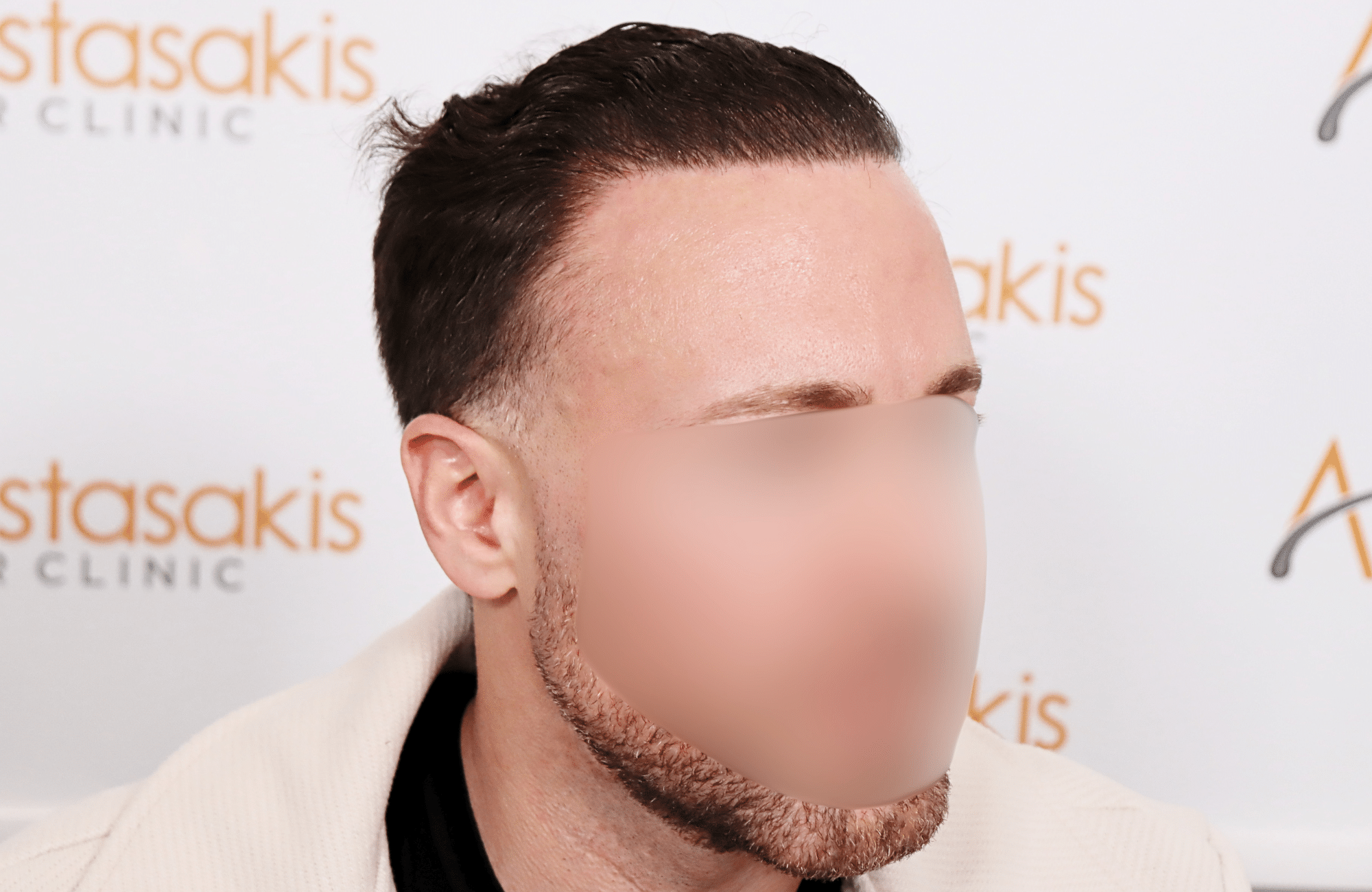hair transplant tesult 2600 fus frontal stage 5