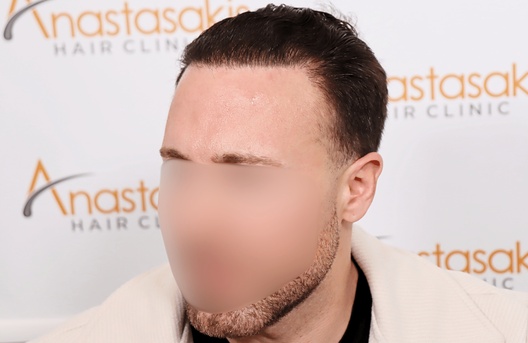 hair transplant tesult 2600 fus frontal stage 5