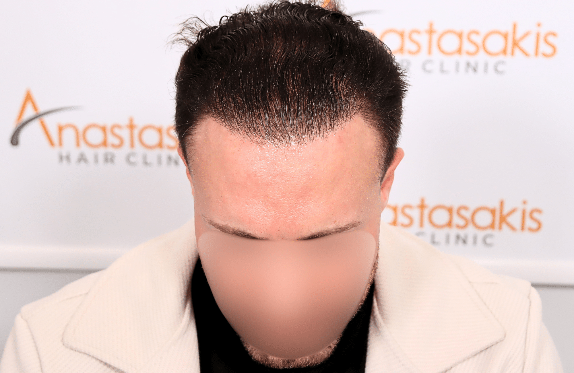 hair transplant tesult 2600 fus frontal stage 5