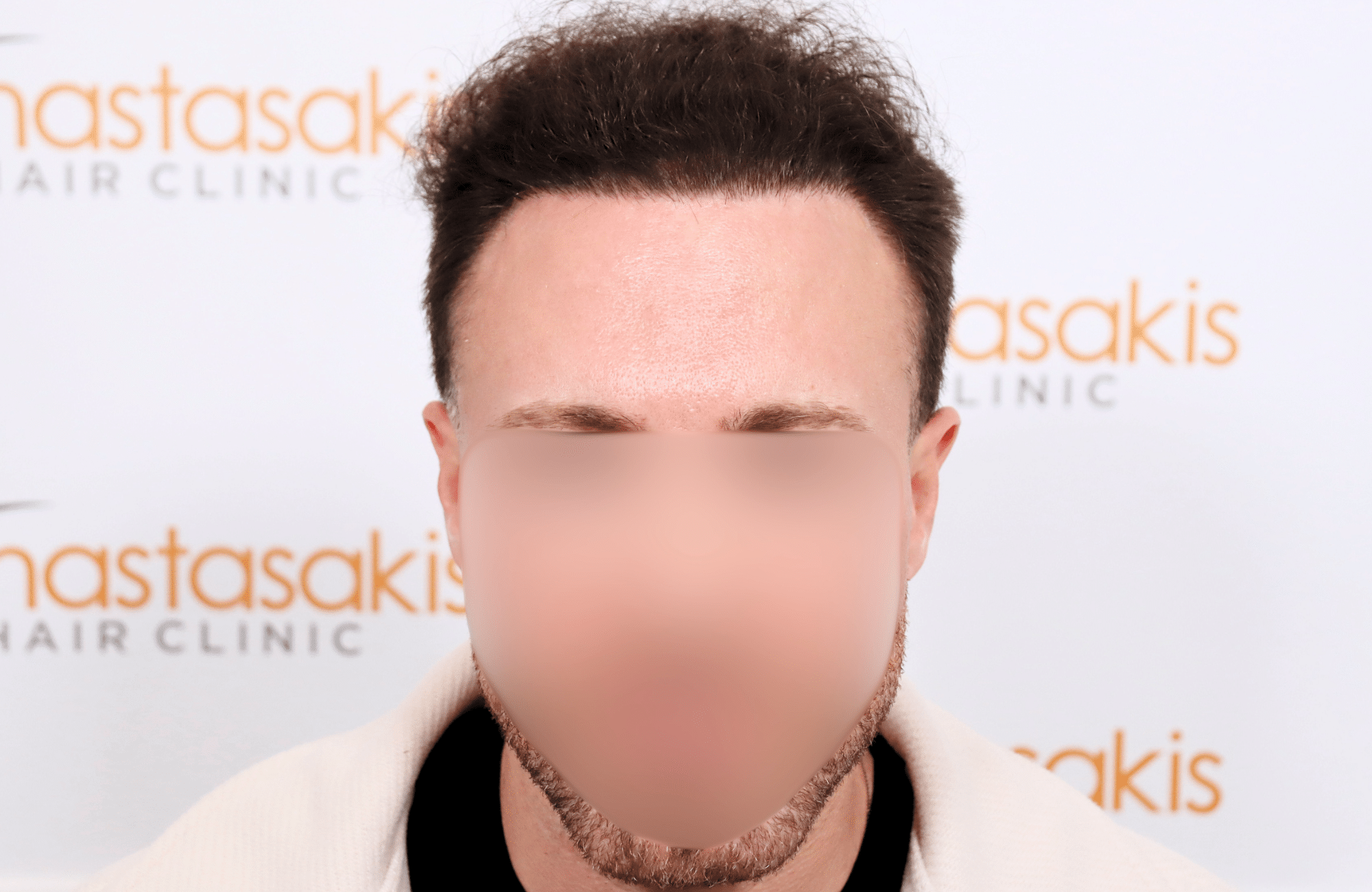 hair transplant tesult 2600 fus frontal stage 5