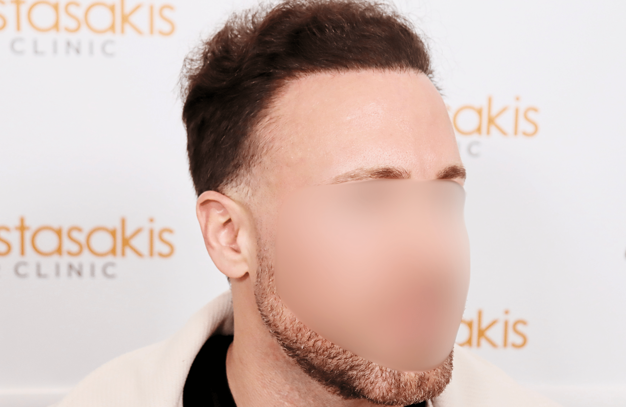 hair transplant tesult 2600 fus frontal stage 5