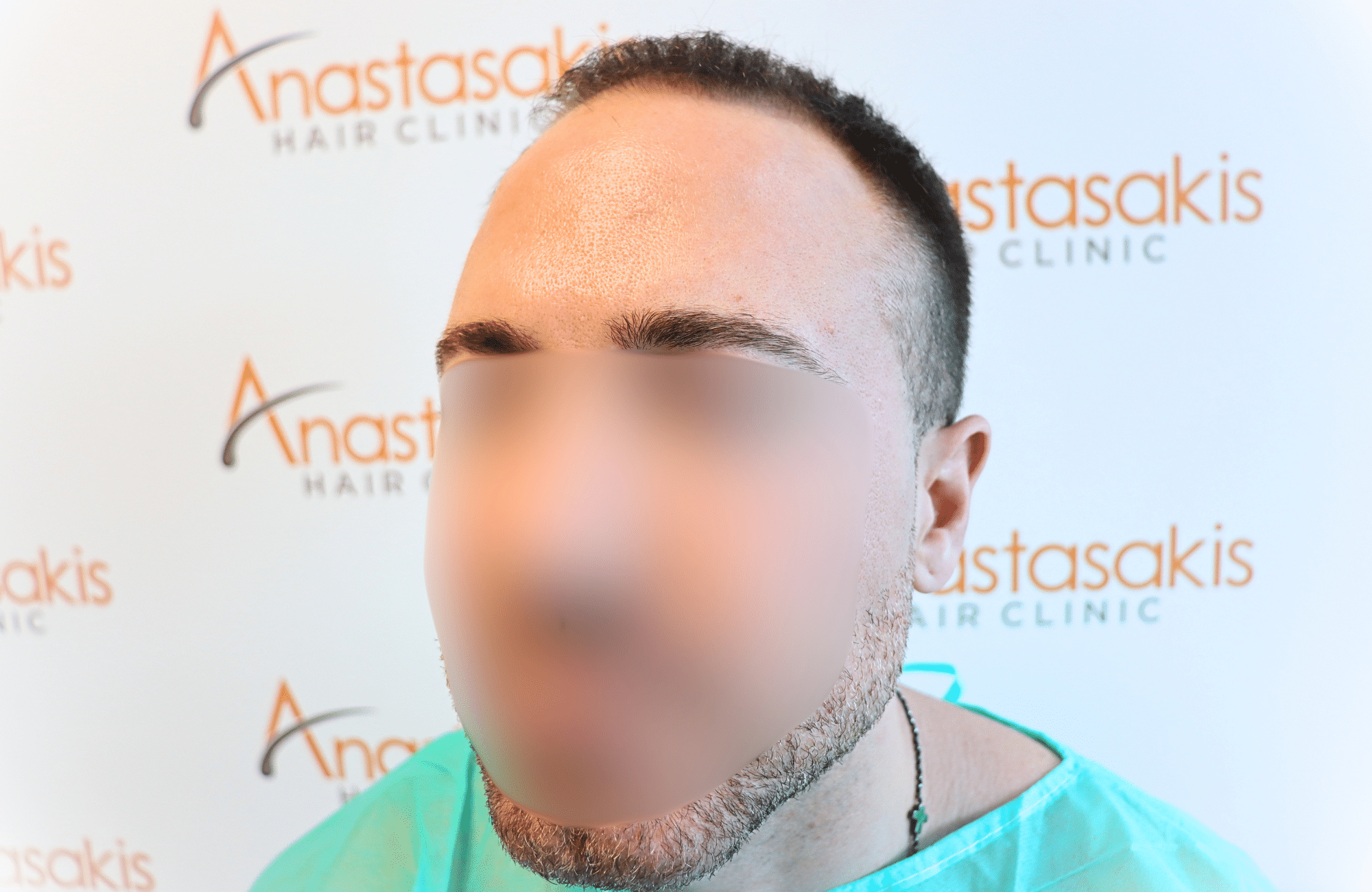 hair transplant tesult 2600 fus frontal stage 5