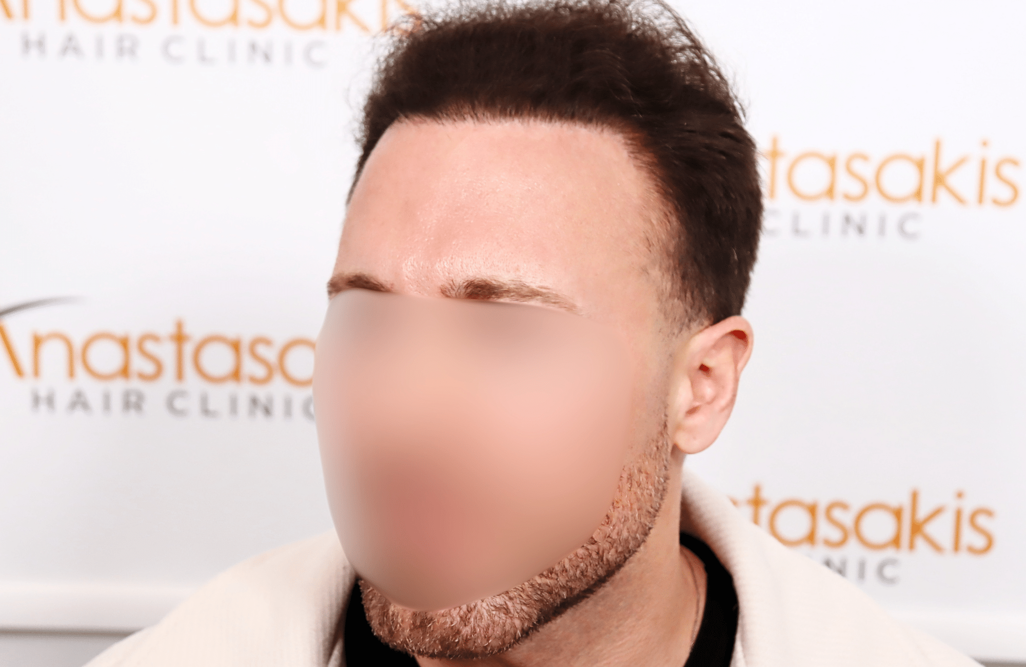 hair transplant tesult 2600 fus frontal stage 5