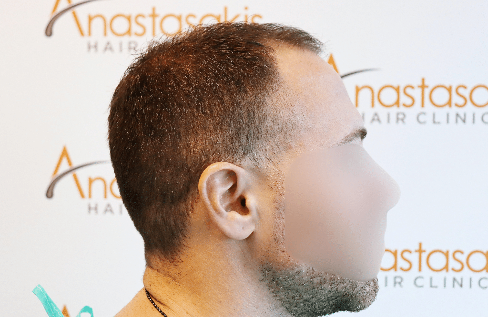 hair transplant tesult 2600 fus frontal stage 5