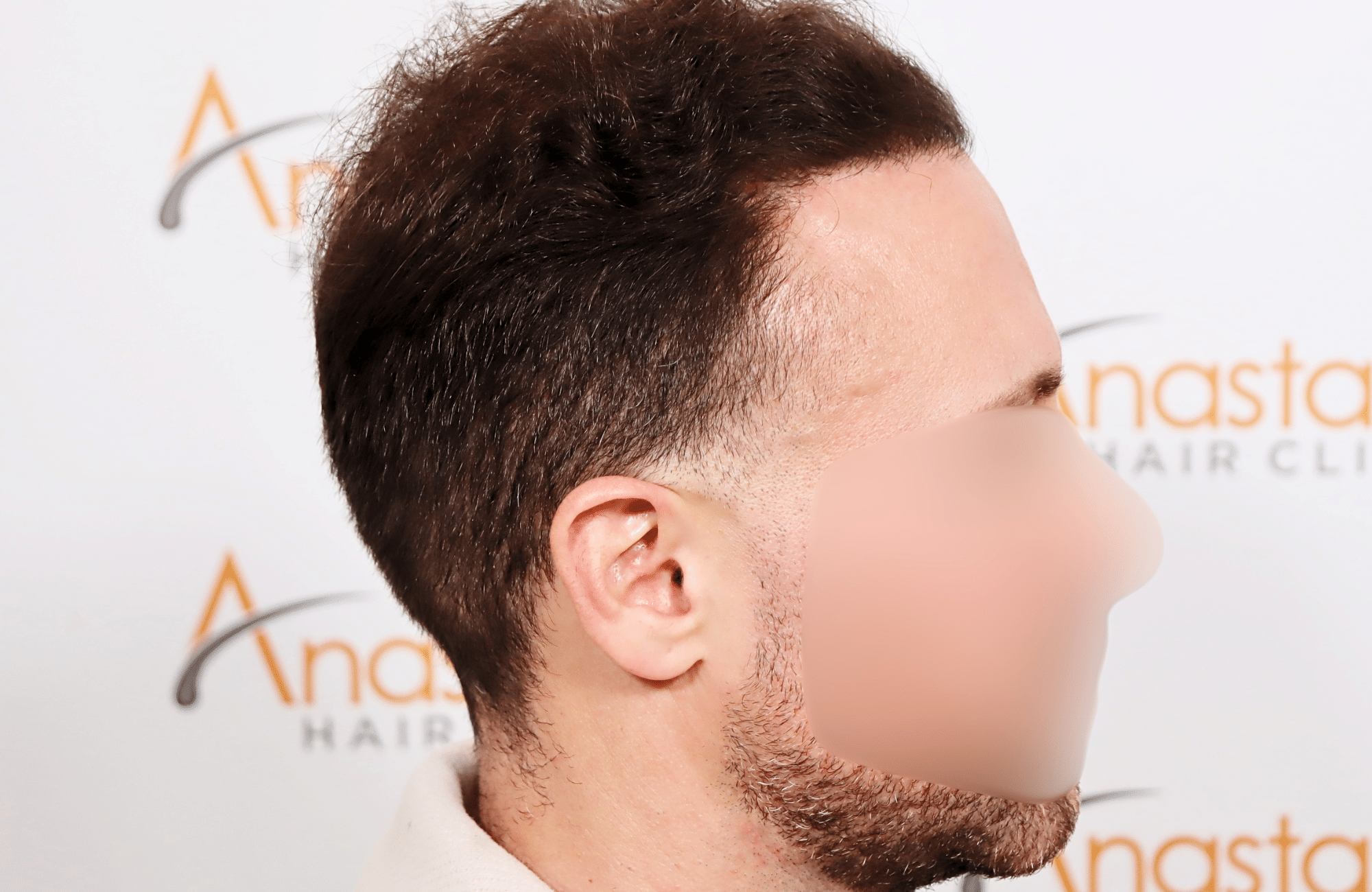 hair transplant tesult 2600 fus frontal stage 5