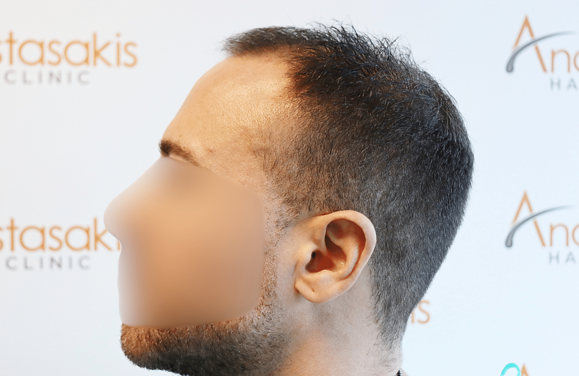 hair transplant tesult 2600 fus frontal stage 5