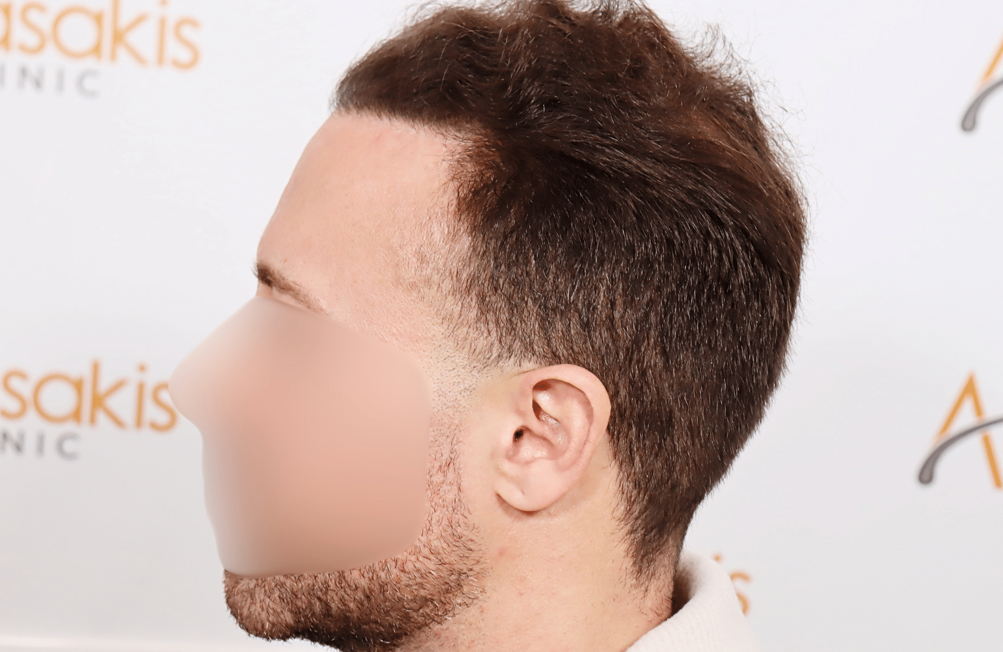 hair transplant tesult 2600 fus frontal stage 5