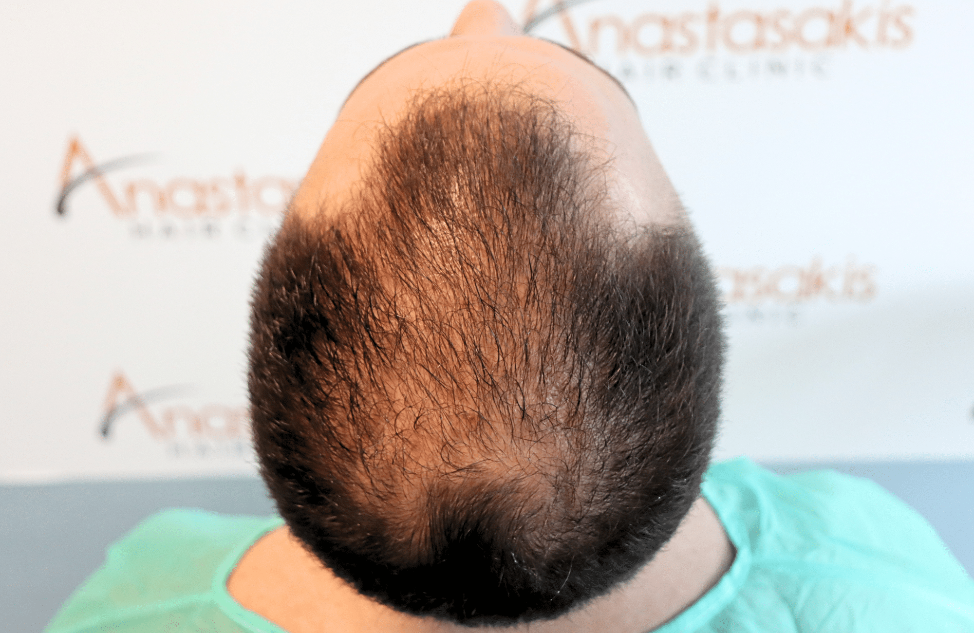 hair transplant tesult 2600 fus frontal stage 5