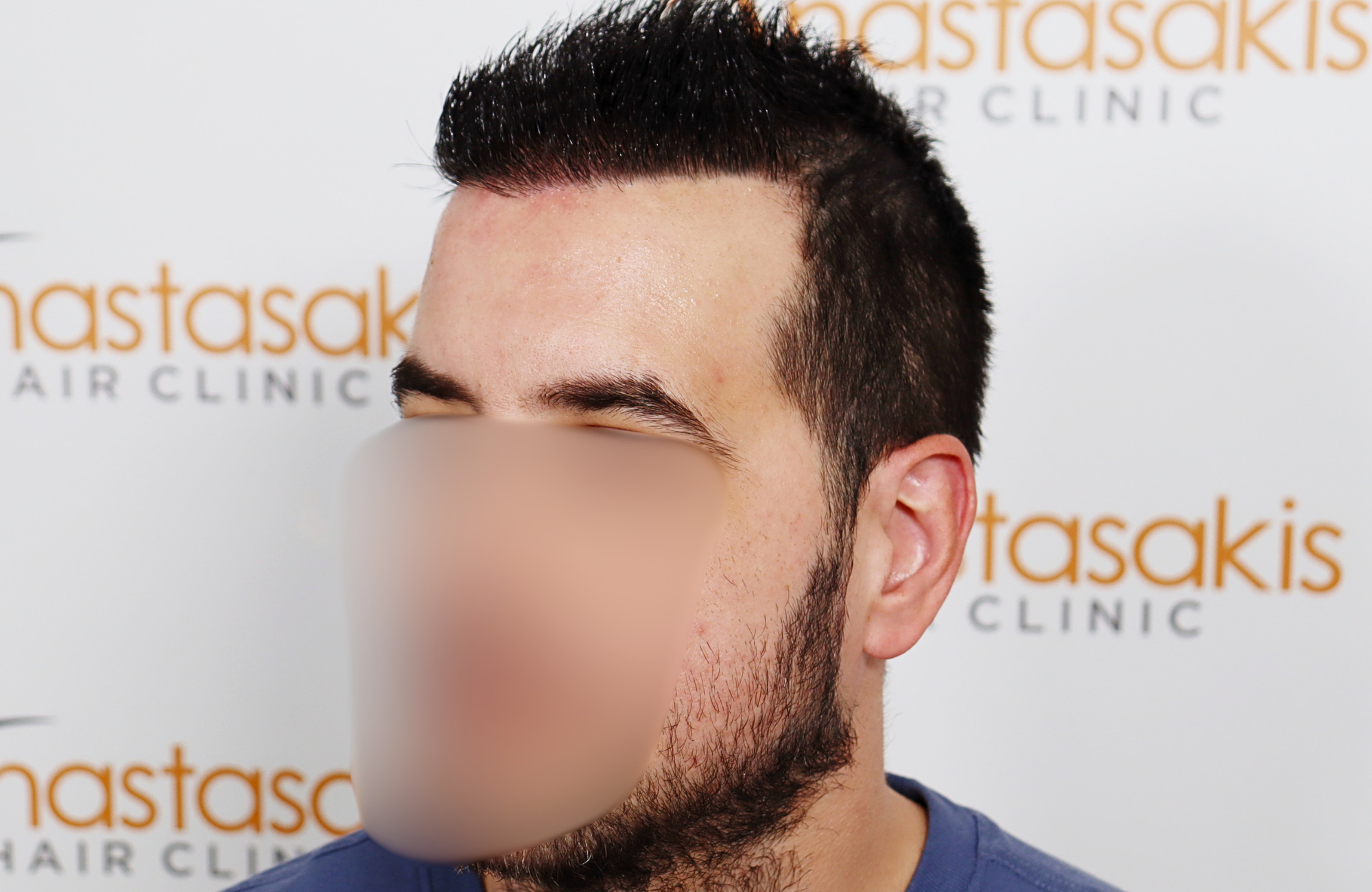 hai transplant result 2400 fus thick diffuse
