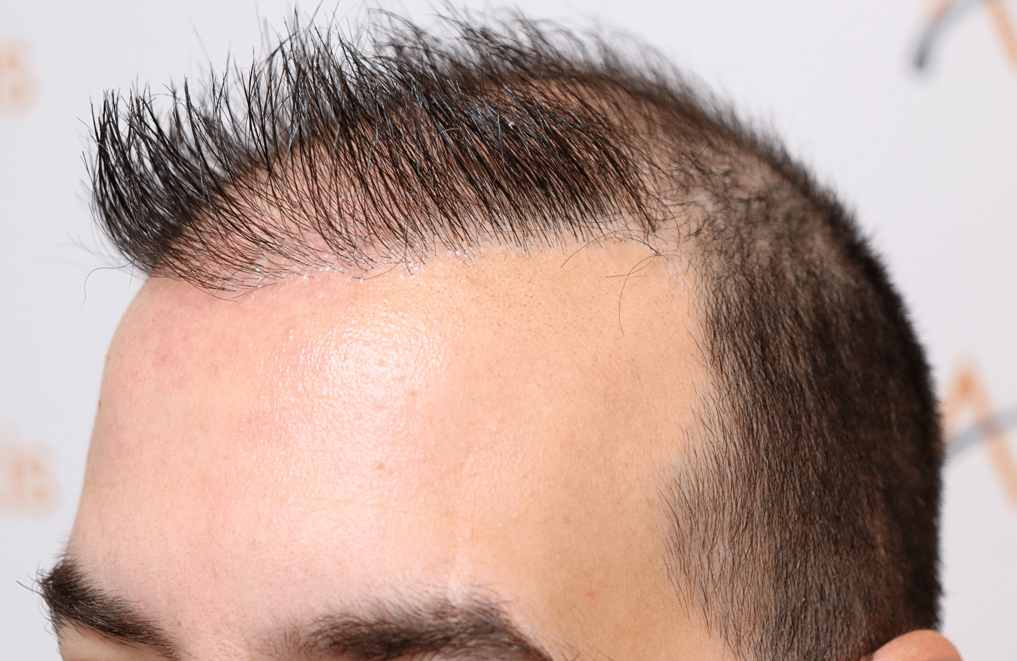 hai transplant result 2400 fus thick diffuse