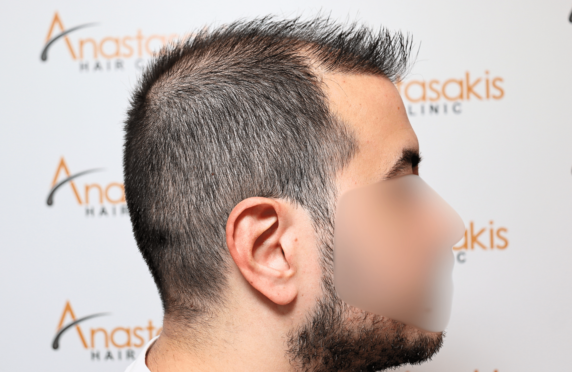 hai transplant result 2400 fus thick diffuse