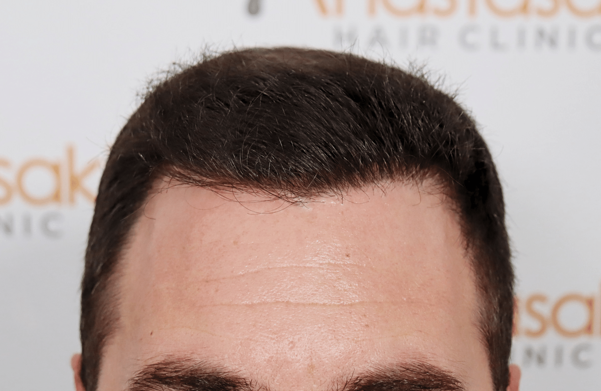 hair transplant result 2500 fus stage4