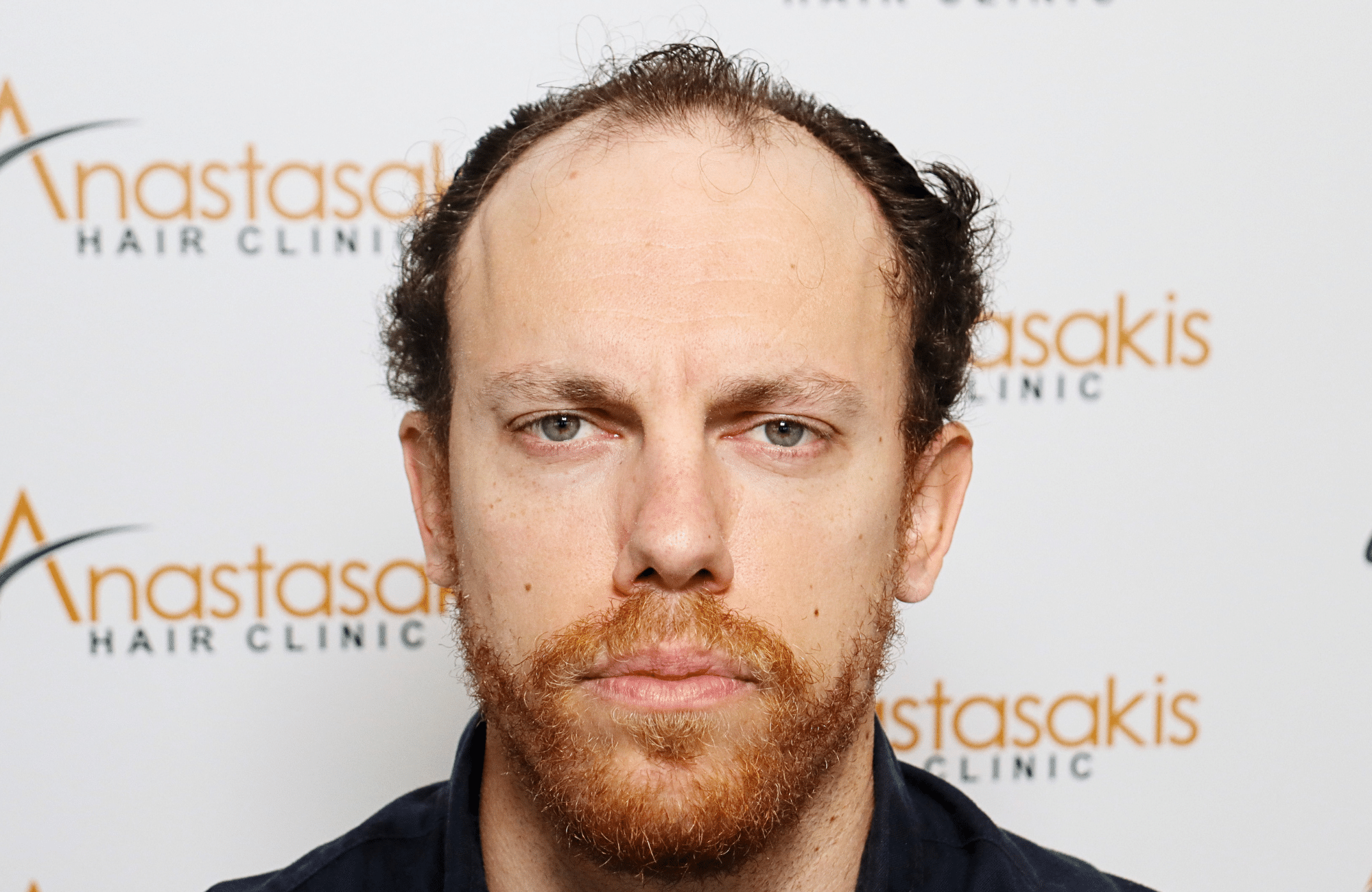 hair transplant result 2600 fus stage 5 1st stage light thick
