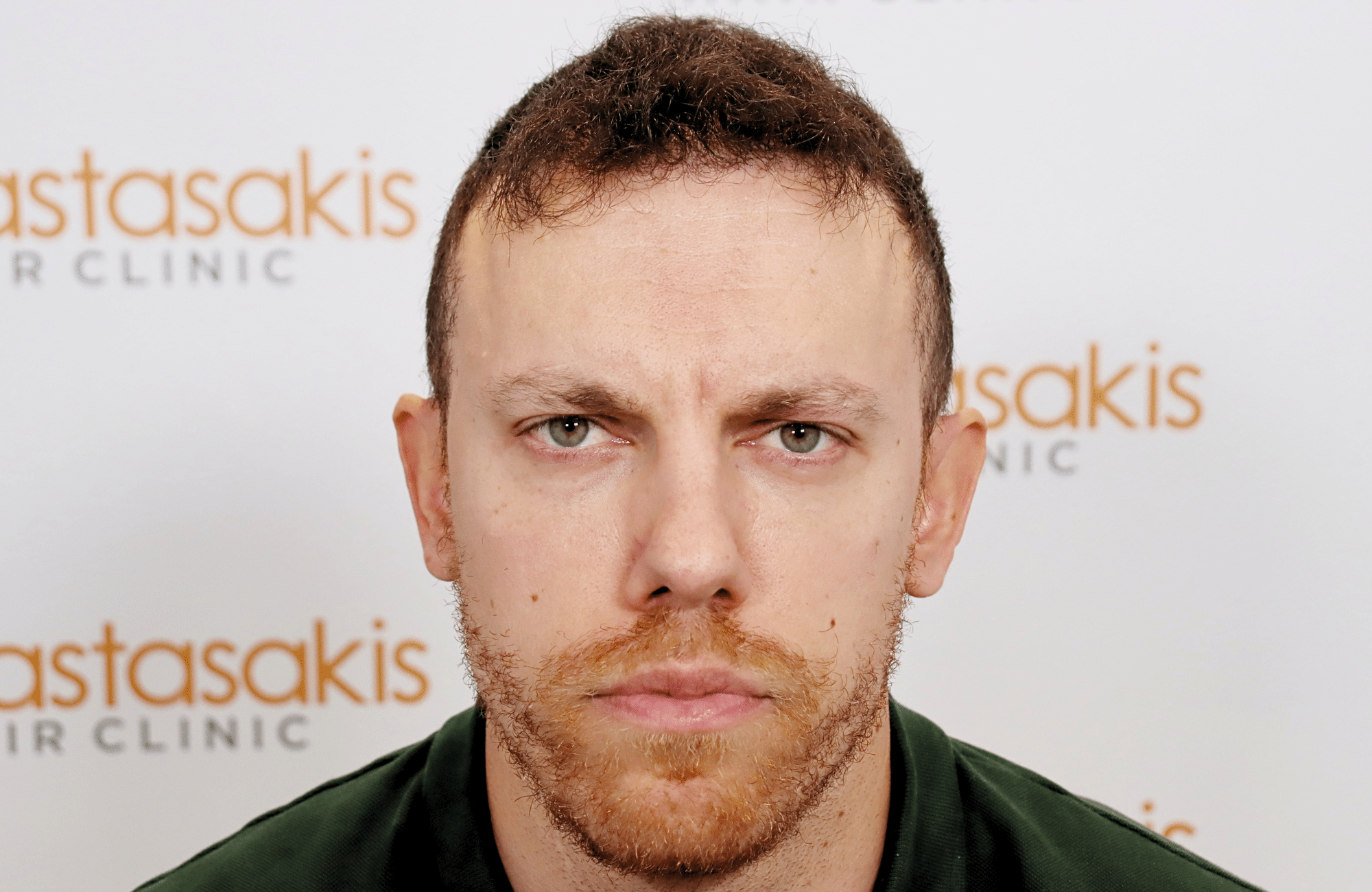 hair transplant result 2600 fus stage 5 1st stage light thick