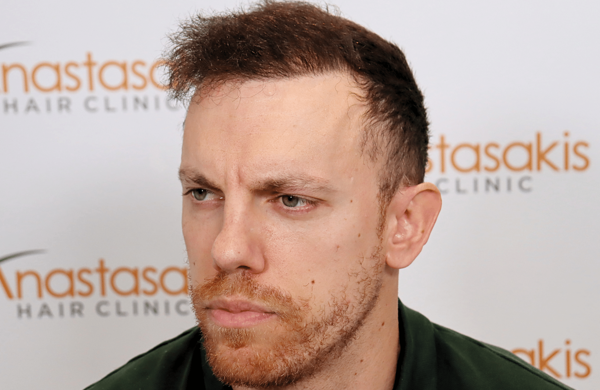 hair transplant result 2600 fus stage 5 1st stage light thick