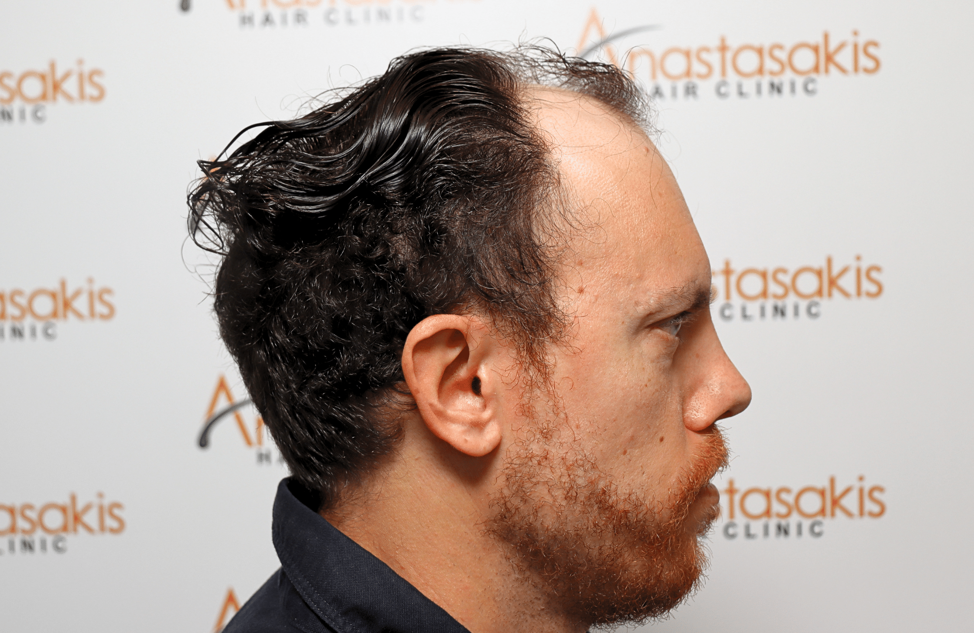 hair transplant result 2600 fus stage 5 1st stage light thick