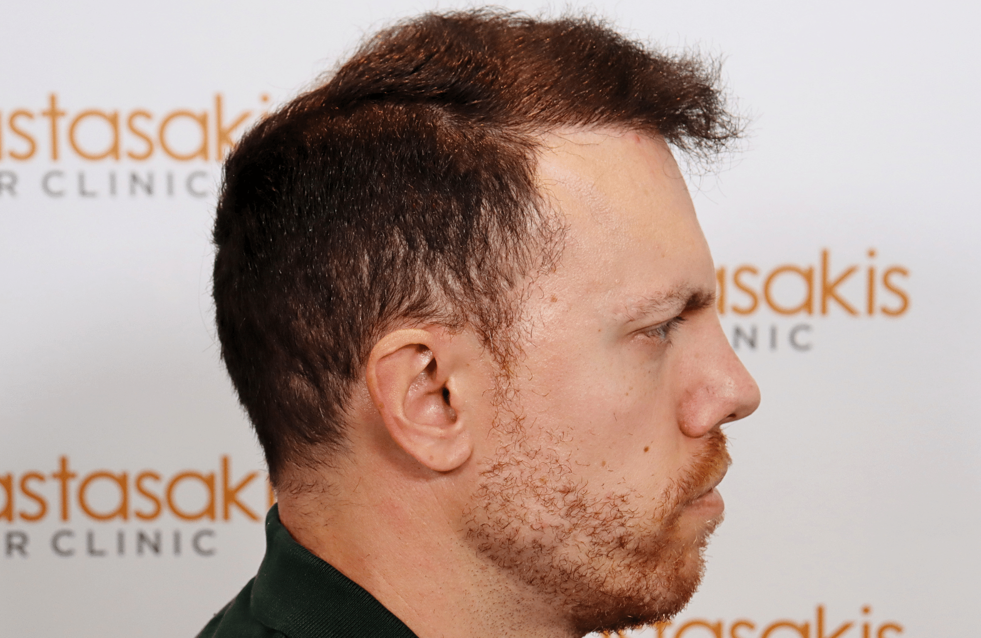 hair transplant result 2600 fus stage 5 1st stage light thick