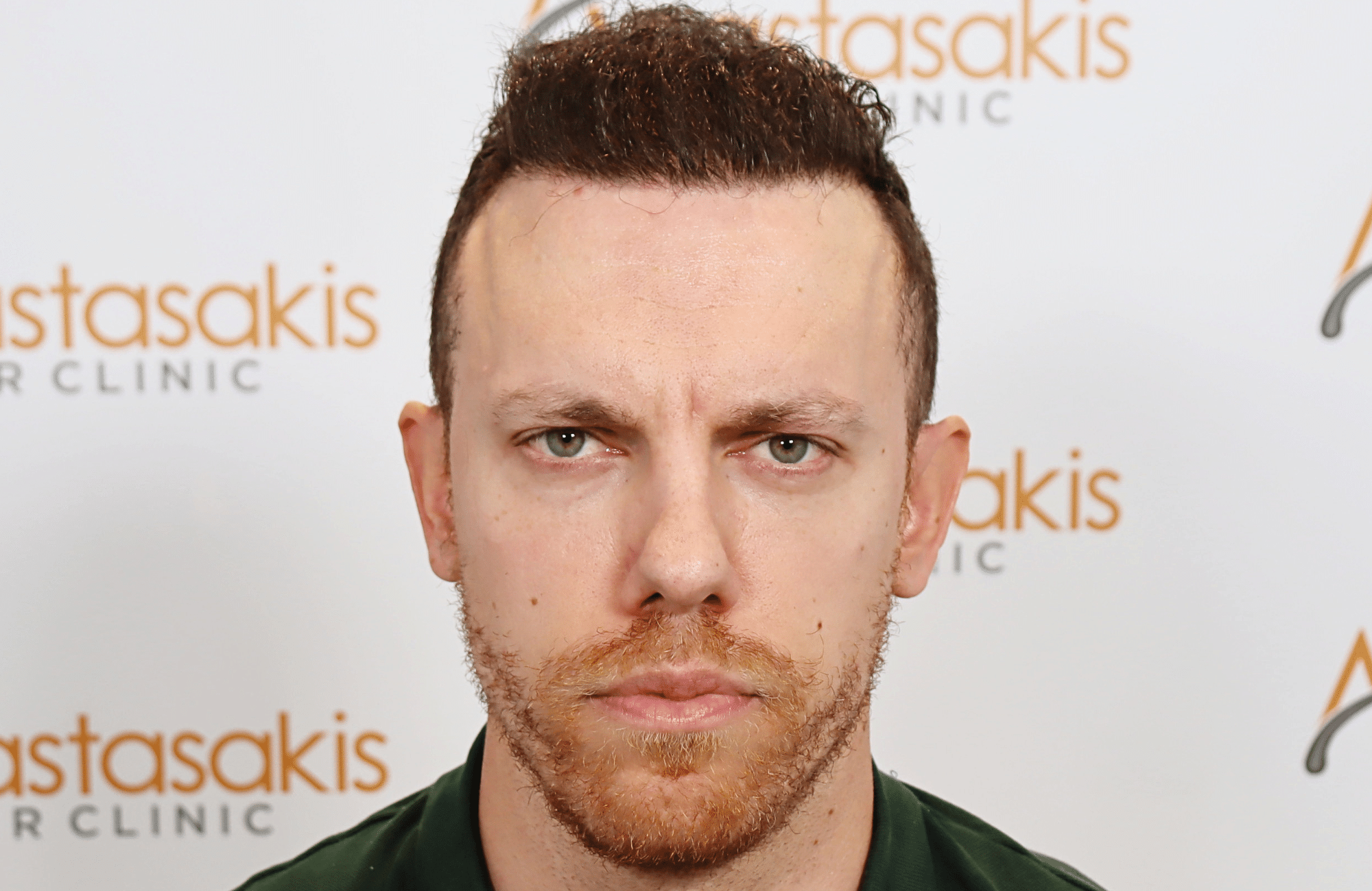 hair transplant result 2600 fus stage 5 1st stage light thick
