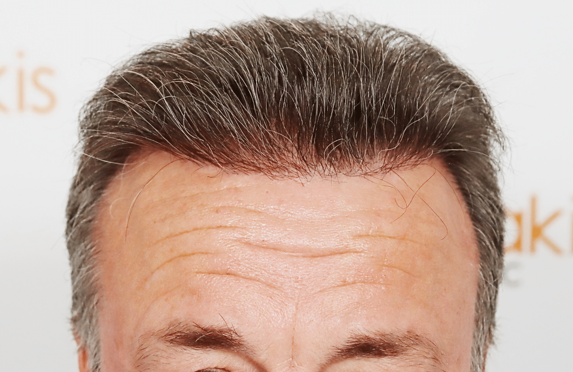hair transplant result 3700 fus frontal stage 5