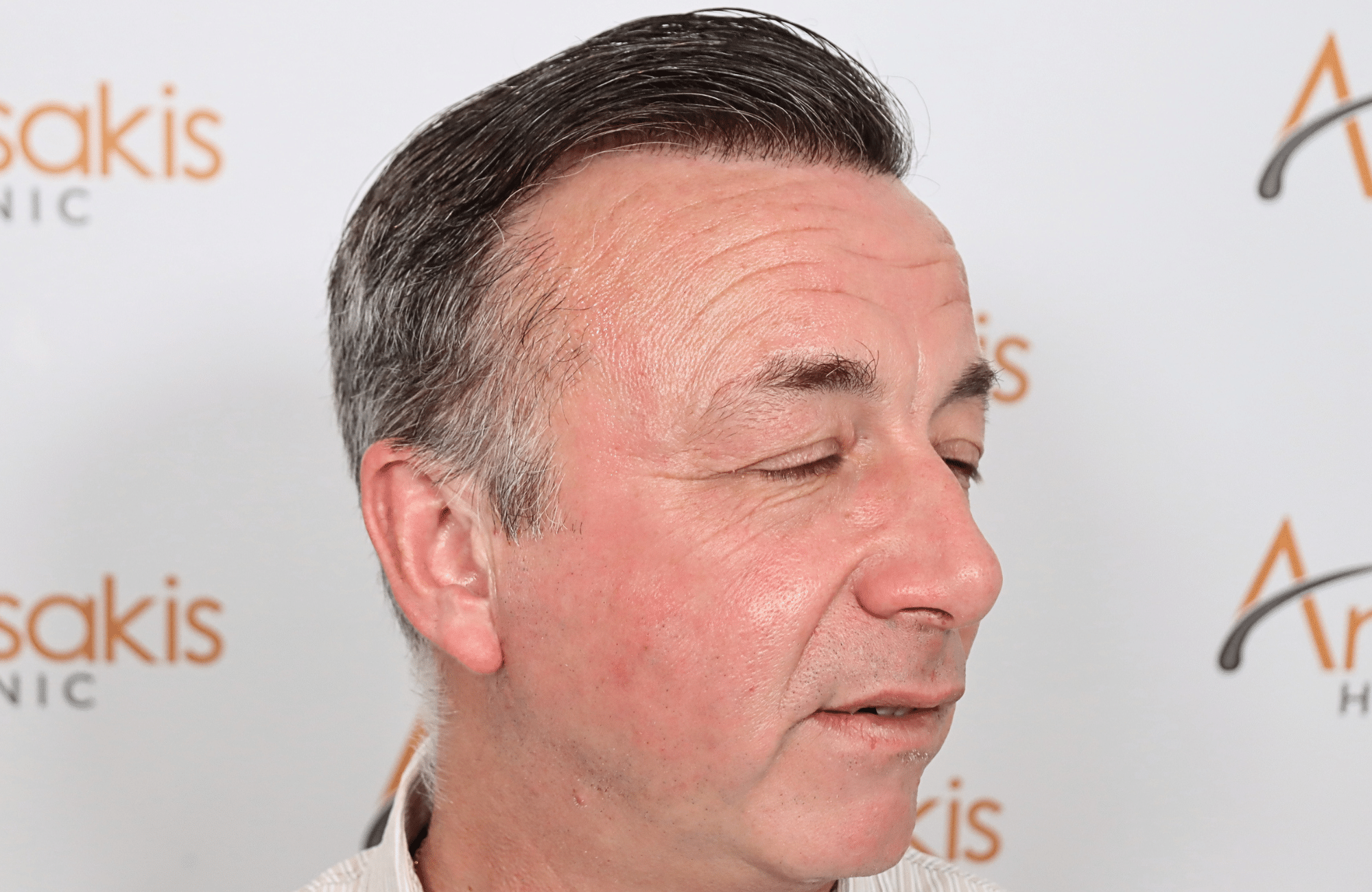 hair transplant result 3700 fus frontal stage 5