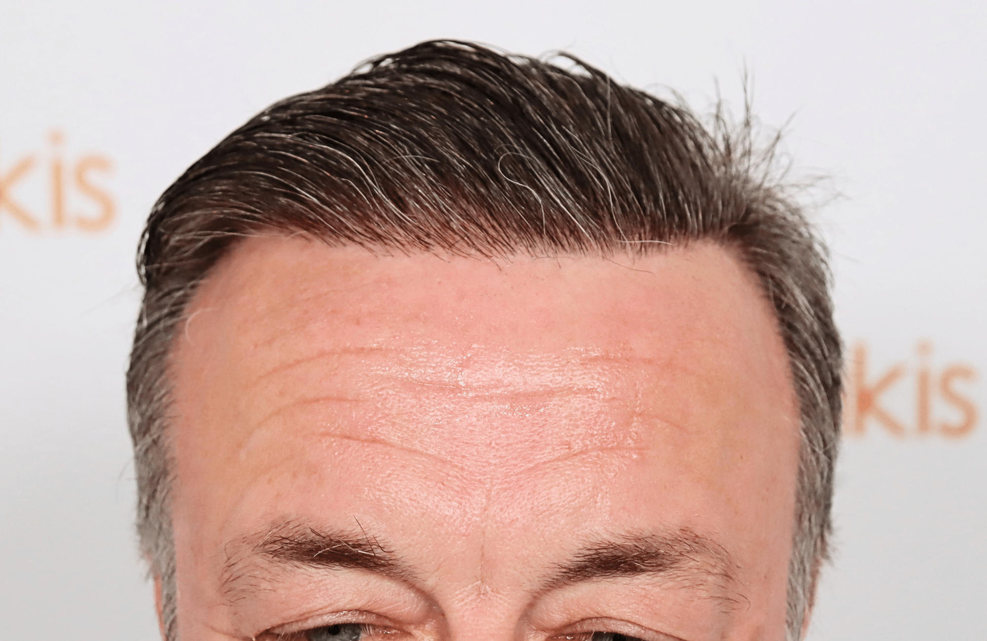 hair transplant result 3700 fus frontal stage 5