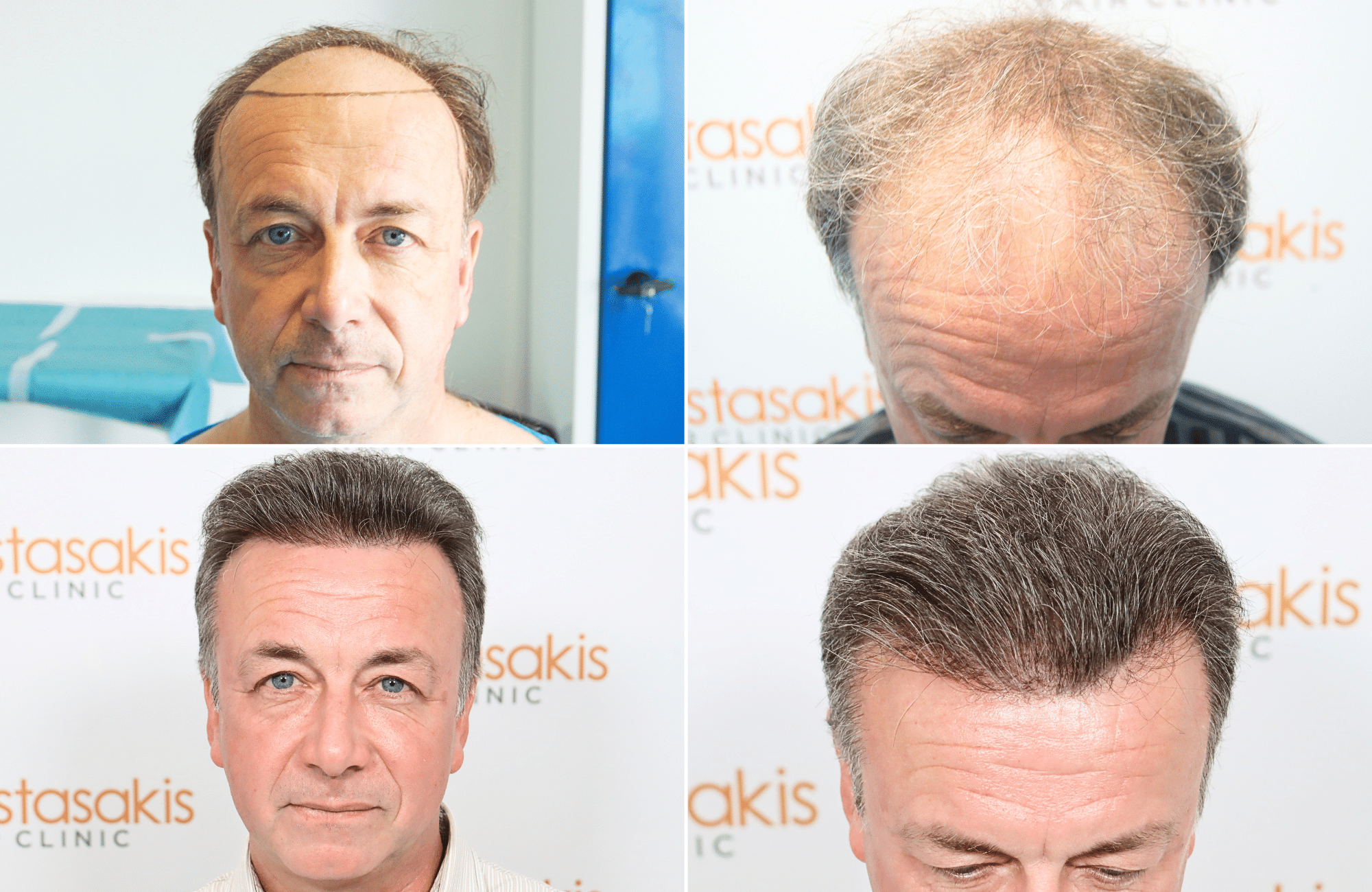 hair transplant result 3700 fus frontal stage 5