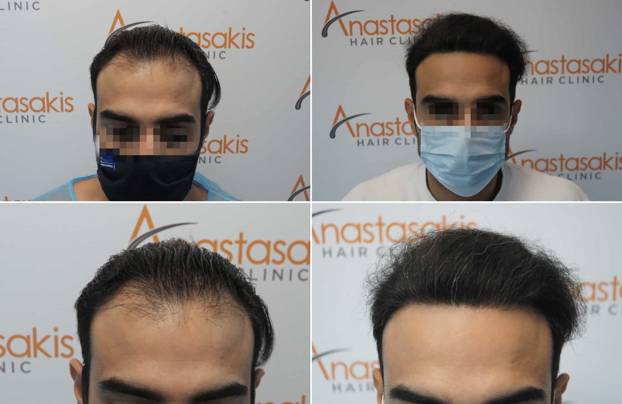 https://anastasakishairclinic.com/portfolio/hair-transplant-result-anastasakis-hair-clinic-345/